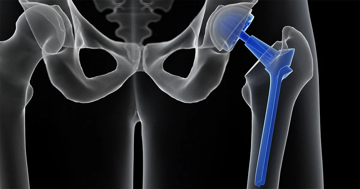 HIP REPLACEMENT SURGERY