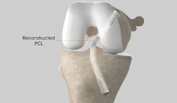 PCL TEAR