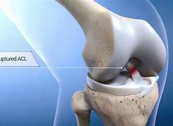 ACL TEAR