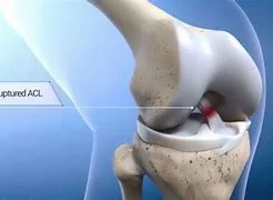 ACL TEAR